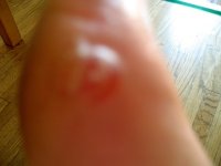 Wound exhibit #3 sand & blood blisters.jpg