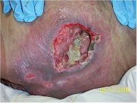 pressure-sore-on-buttock.jpg