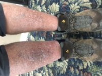 legs before hospital.jpg